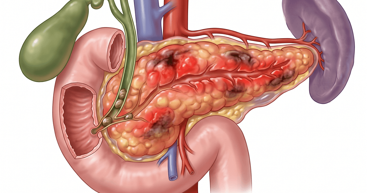 Pancreatite aguda, sintomas, causas e tratamento